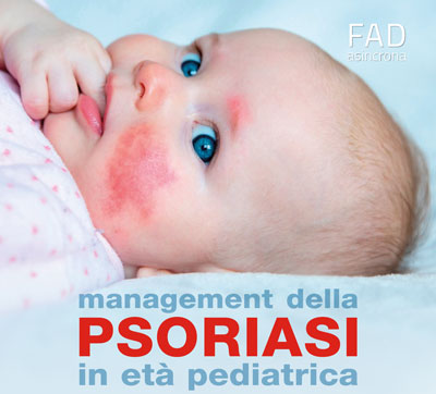 Management della psoriasi in età pediatrica