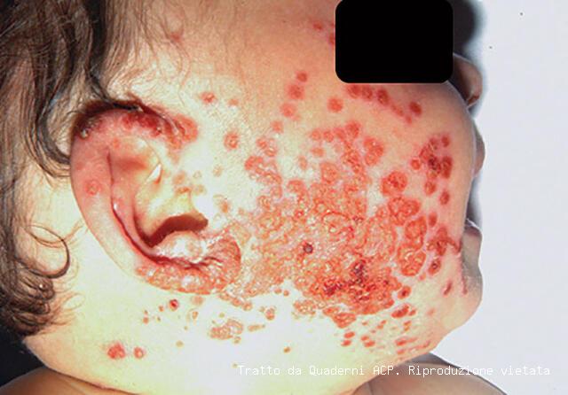 Marco ha prurito - - Blog di dermatologia pediatrica - SIDerP