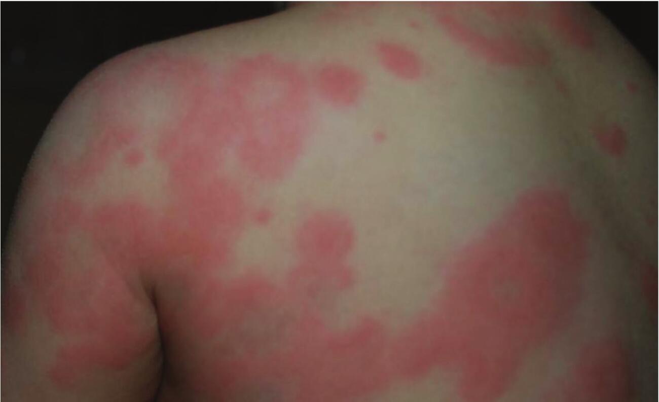Un pomfo vuol dire sempre orticaria... o no?