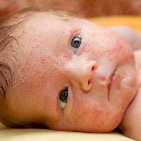 Nuovo corso FAD: La gestione dell'acne in pediatria