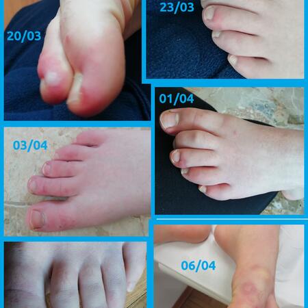 Segni cutanei in epoca Covid-19