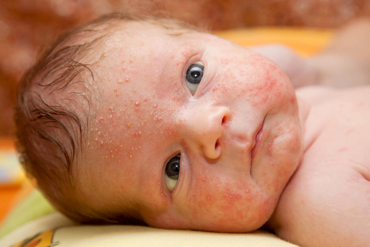Nuovo corso FAD: La gestione dell'acne in pediatria